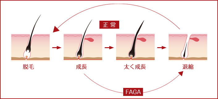 脱毛のメカニズム